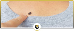 Skin Lesion Removal in High Desert Area Skin Lesion Removal in High Desert Area