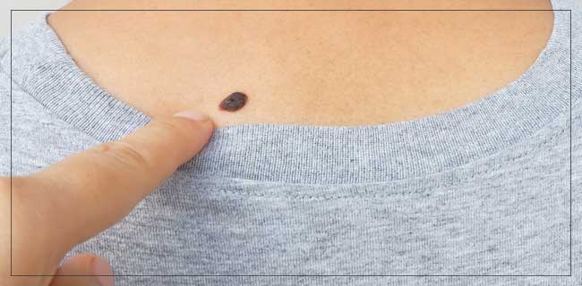 Skin Lesion Removal Specialist Near Me in Apple Valley, CA and Victorville, CA Skin Lesion Removal Specialist Near Me in Apple Valley, CA and Victorville, CA